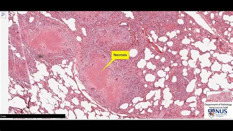 Lung Miliary Tb Microscopy Talking Slide Youtube