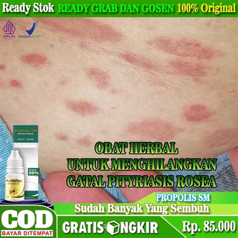 Jual Obat Pityriasis Rosea Kurap Ruam Pada Kulit Gatal Ruam Merah