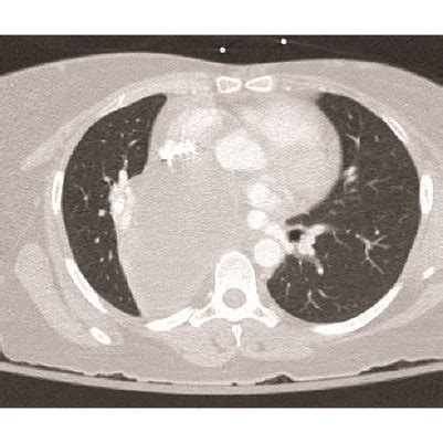 A The Patients Large Right Mediastinal Bronchogenic Cyst Displacing