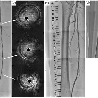 (a) Preoperative angiography of the right SFA, (b) preoperative ...