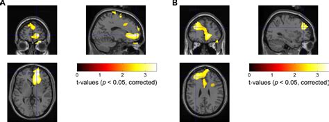 Increased Theta Alpha Synchrony In The Habenula Prefrontal Network With