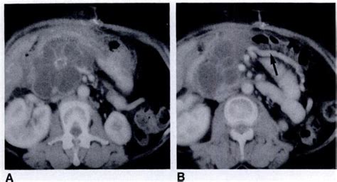 Biopsy Proved Mucinous Cystadenocarcinoma Of Head Of Pancreas In A