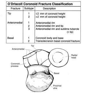 Coronoid Fractures - Trauma - Orthobullets