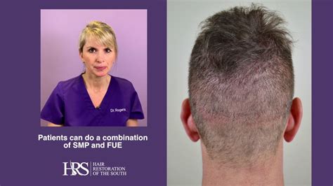 Hair Transplant Donor Scar Repair With Smp And Fue Youtube