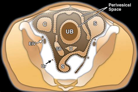 Uncommon Primary Pelvic Retroperitoneal Masses In Adults A Pattern Based Imaging Approach