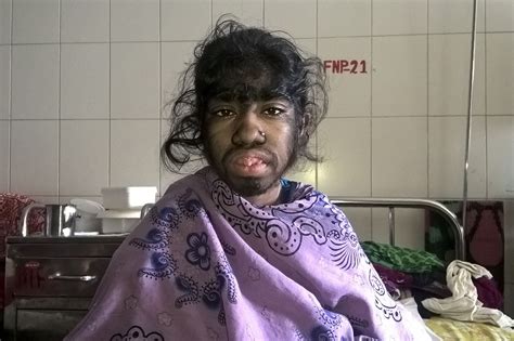 Babies contract 'Werewolf Syndrome' from tainted formula