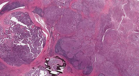 Poorly Differentiated Thyroid Carcinoma Atlas Of Pathology