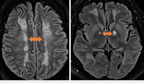 Mri Of The Brain T Flair Sequence Axial Images With Confluent White