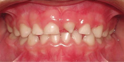 Initial Clinical Aspect Supernumerary Peg Shaped Tooth In The Anterior Download Scientific