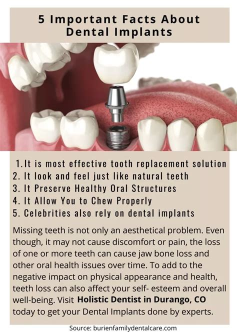 PPT 5 Important Facts About Dental Implants PowerPoint Presentation