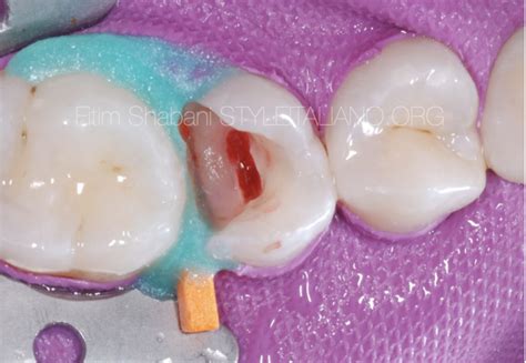 Pulpotomy In Mature Permanent Teeth Part II Style Italiano Endodontics