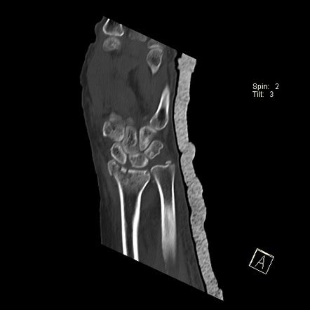 Distal Radius Fracture Frykman Type Viii Image Radiopaedia Org