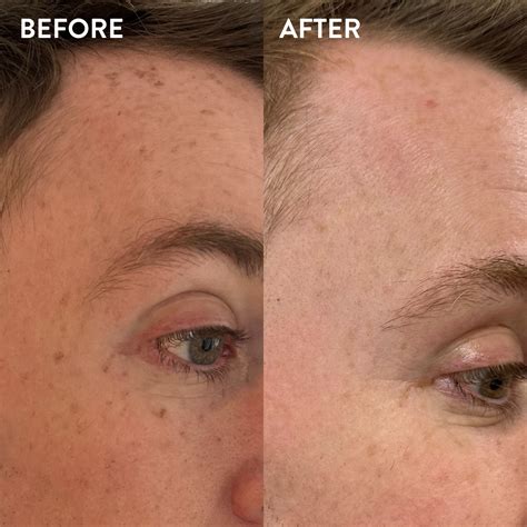 Laser Pigmentation Removal Off And On — Off And On