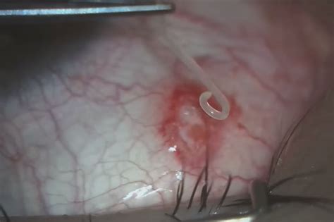 Eye Worm Removed From Mans Eye In Stomach Churning Operation Footage
