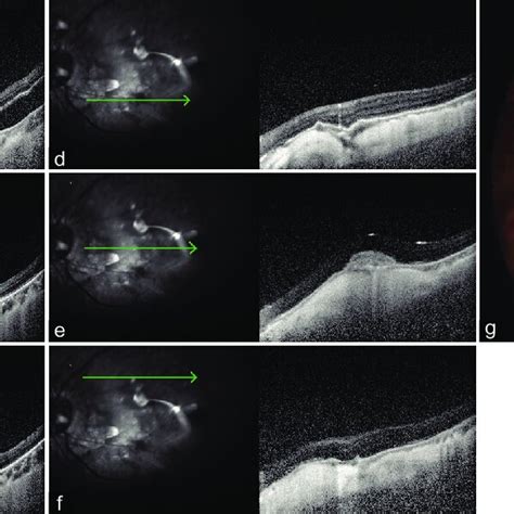 A Preoperative Line Scan Spectral Domain Optical Coherence Tomography