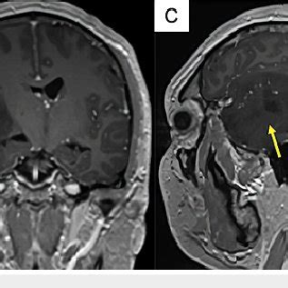 Contrast-enhanced MRI and DTI tractography. Contrast-enhanced MRI: (A ...