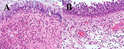 Typical Nasal Polyp Tissue With A Marked Eosinophil Infiltration