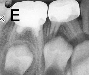 A Preoperative Periapical Radiograph Showing An Extensive Internal