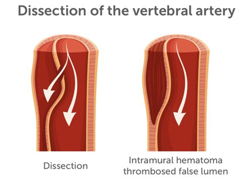 13 Vertebral Artery Pathologies 123sonography