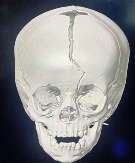 Figure Diastatic Fracture Involving Superior Sagittal