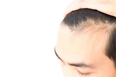 Five Ways To Help Prevent Hair Loss In Men Lifestyle The Jakarta Post