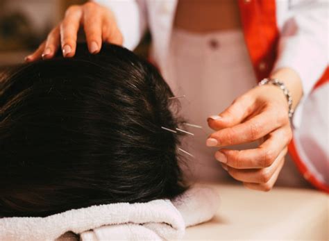 Can Acupuncture Help With Alopecia