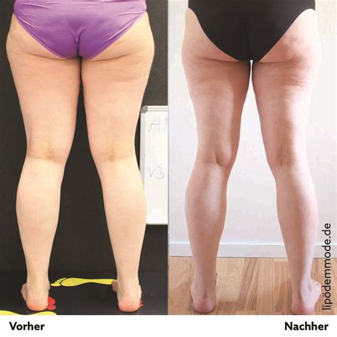 Lipoedem Mode Liposuktion Beine Vorher Nachher How To Better Yourself