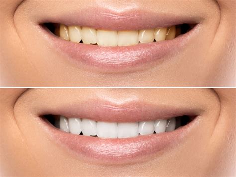 Teeth Whitening In Bridgewater Aesthetic Dental Medium