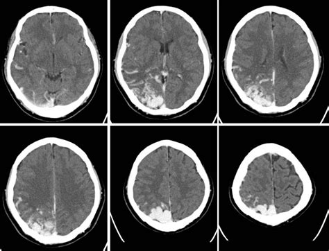 Cerebral Arteriovenous Malformations Radiology Cases