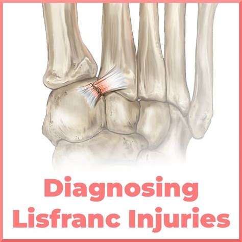 Diagnosing A Lisfranc Injury Rpodiatry