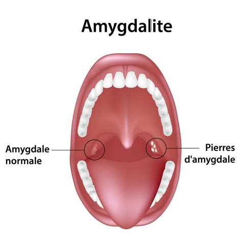 Angine blanche symptômes causes et traitements Information