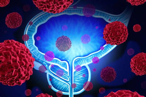 Tumore Alla Prostata Il Ruolo Del Microbiota Sulla Terapia Ormonale