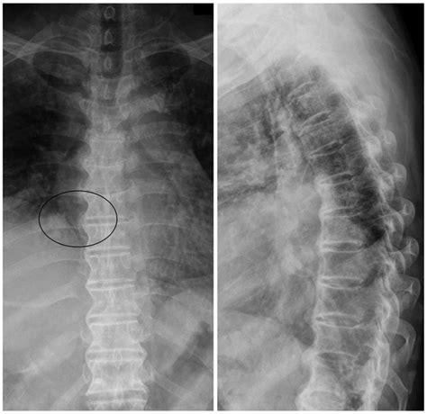 Spine Tumor On X Ray Hot Sex Picture