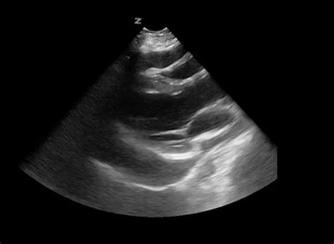 Pericardiocentesis Ultrasound Guided