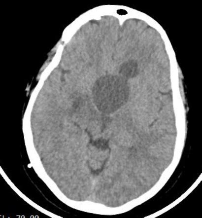 Craniopharyngioma Image Radiopaedia Org