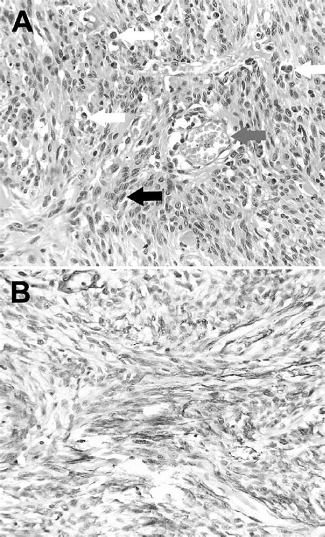 A Spindle Cells Are Arranged In Sheets And Short Fascicles Admixed