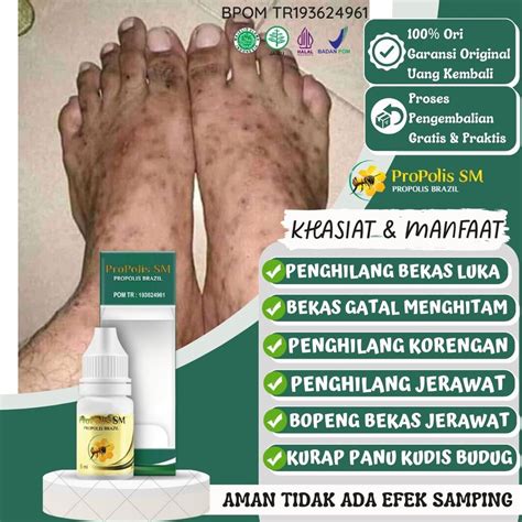 Jual Obat Penghilang Bekas Luka Hitam Seluruh Badan Gatal Penghilang