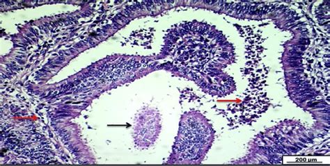 Photomicrograph Of Uterine Tube Shows Moderate Infiltration Of