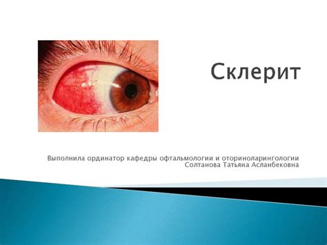 Офтальмология. Склерит - презентация онлайн