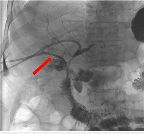 Percutaneous Transhepatic Cholangiogram Ptc Demonstrates Two