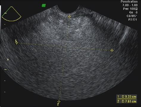 adnexal cyst | Semantic Scholar