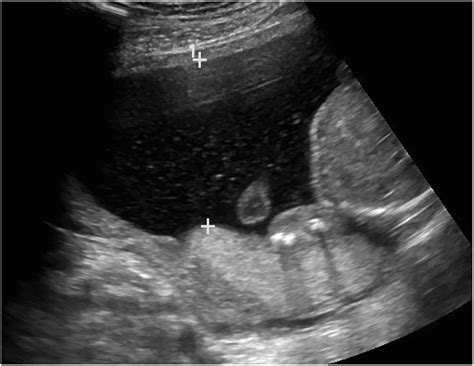 SMFM Fetal Anomalies Consult Series 4 Genitourinary Anomalies