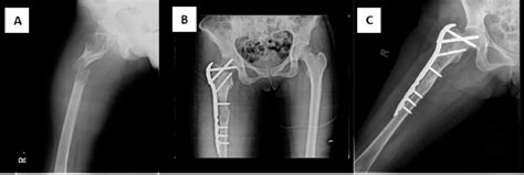 Preoperative Radiograph Of Patient Number 5 Showing Simple Bone Cyst Download Scientific