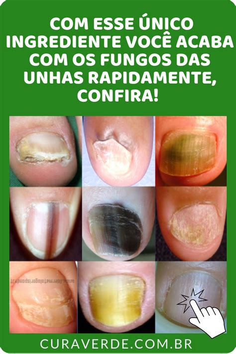 Receita Caseira Para Fungo nas Unhas Mate os Fungos Rápido e Fácil