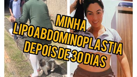 Cicatriz Da Minha Abdominoplastia Ap S Dias Como Ficou Youtube