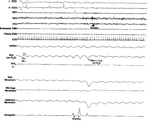 Figure 2 From Upper Airway Resistance Syndrome After