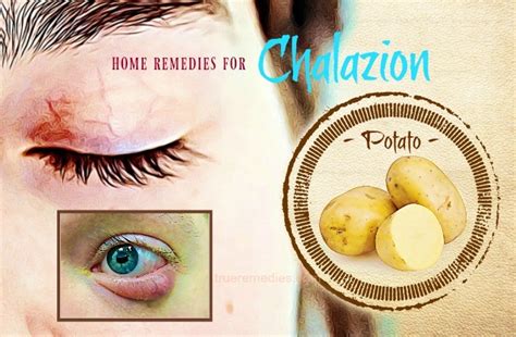 38 Natural Home Remedies For Chalazion Cysts On The Eyelid