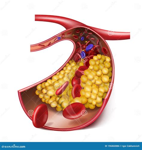 Atherosclerosis Levels The Accumulation Of Cholesterol In The Blood