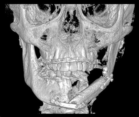 Ameloblastic Fibrosarcoma Of The Mandible Case Report And Literature