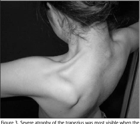 Figure From Spinal Accessory Nerve Palsy Evaluation Of Four Atypical